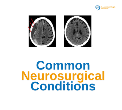 Common Neurosurgical Conditions: Understanding Diagnosis and Treatment