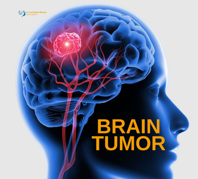 Brain Tumors: Signs, Symptoms, and Advances in Treatment