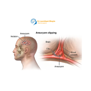 Brain Aneurysm Surgery