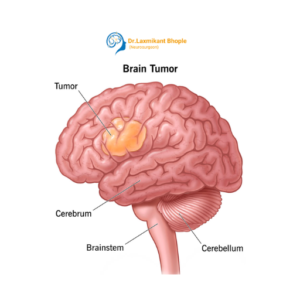 Brain Tumor