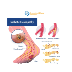 Diabetic Neuropathy Management