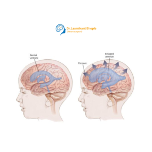 Hydrocephalus