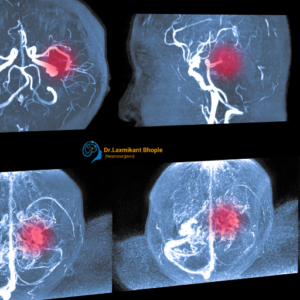 Brain Tumour & Aneurysm