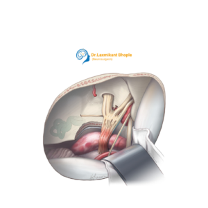 Microsurgical Neurovascular Procedures