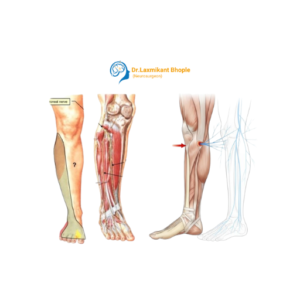 Peroneal Nerve Injury