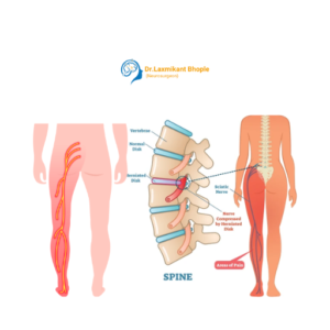 Sciatica Pain Management