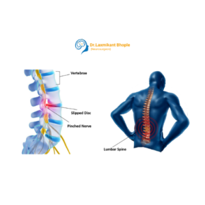Slip Disc (Cervical & Lumbar)