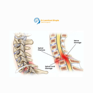 Spine Fractures & Trauma