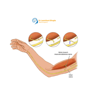Traumatic Nerve Injury Repair