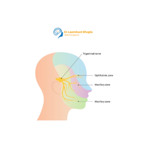 Trigeminal Neuralgia